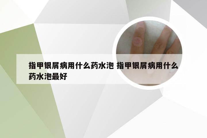 指甲银屑病用什么药水泡 指甲银屑病用什么药水泡最好