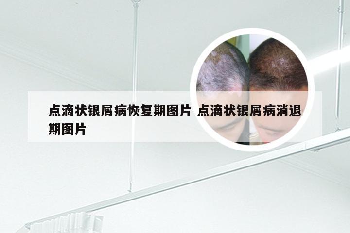 点滴状银屑病恢复期图片 点滴状银屑病消退期图片