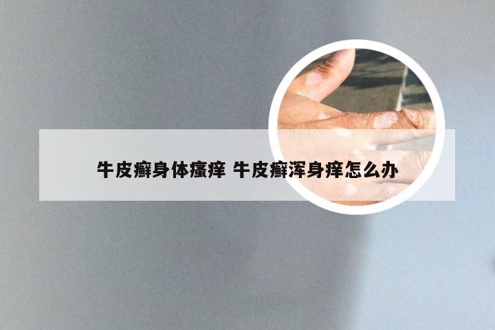牛皮癣身体瘙痒 牛皮癣浑身痒怎么办