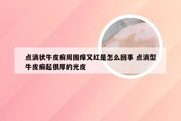 点滴状牛皮癣周围痒又红是怎么回事 点滴型牛皮癣起很厚的光皮