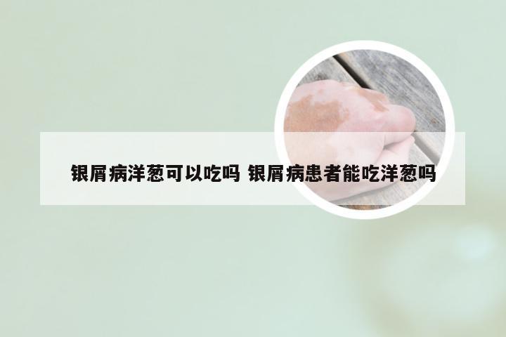 银屑病洋葱可以吃吗 银屑病患者能吃洋葱吗