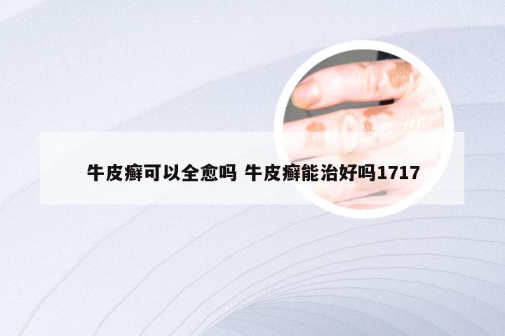牛皮癣可以全愈吗 牛皮癣能治好吗1717