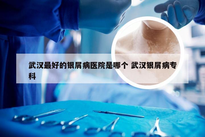 武汉最好的银屑病医院是哪个 武汉银屑病专科