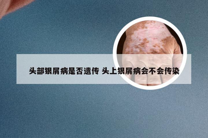 头部银屑病是否遗传 头上银屑病会不会传染