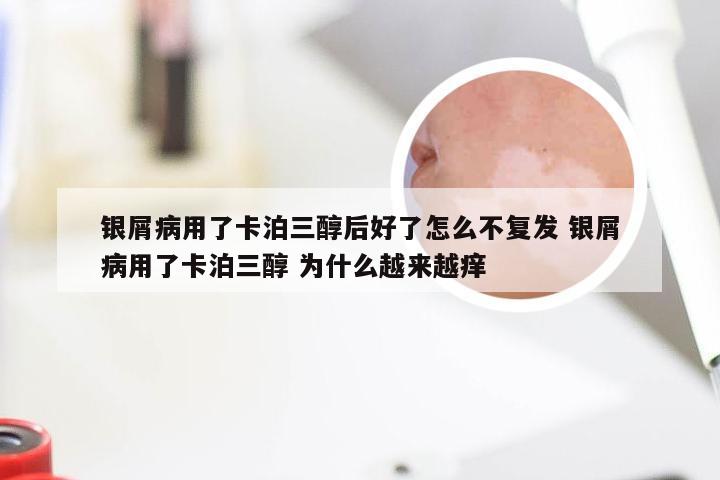 银屑病用了卡泊三醇后好了怎么不复发 银屑病用了卡泊三醇 为什么越来越痒