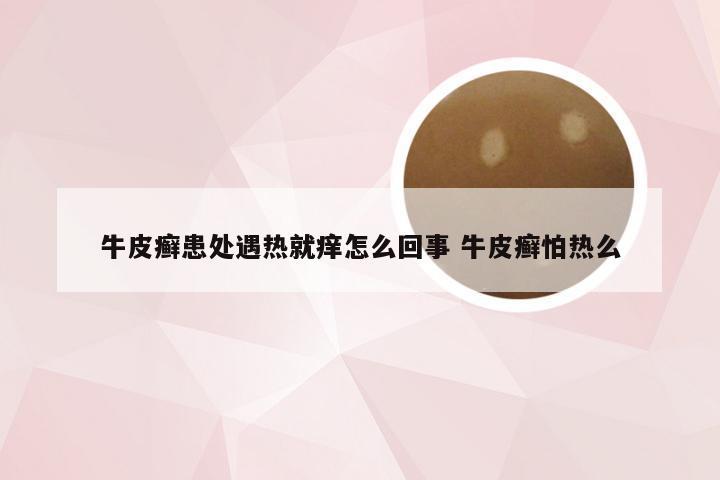 牛皮癣患处遇热就痒怎么回事 牛皮癣怕热么