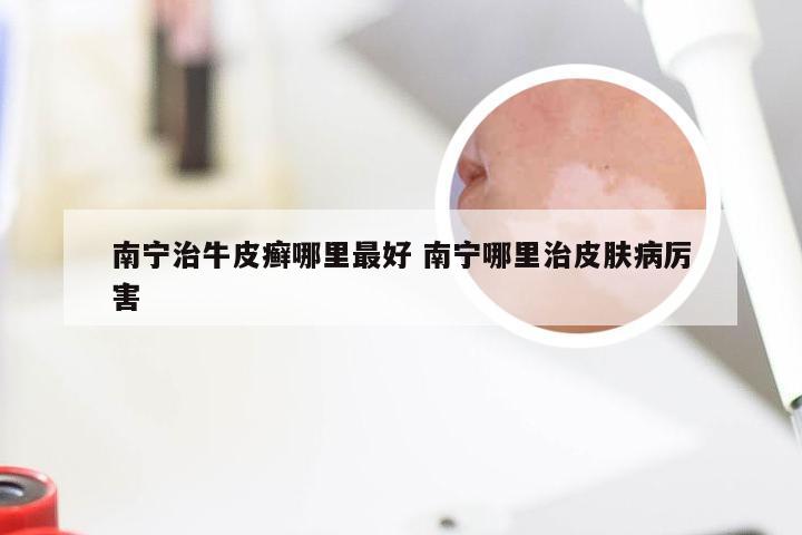 南宁治牛皮癣哪里最好 南宁哪里治皮肤病厉害
