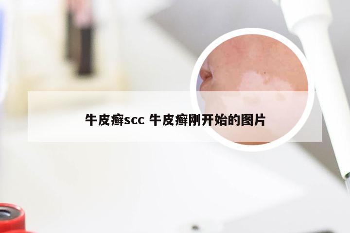 牛皮癣scc 牛皮癣刚开始的图片