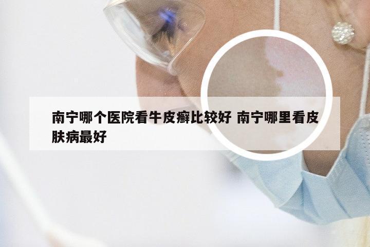 南宁哪个医院看牛皮癣比较好 南宁哪里看皮肤病最好