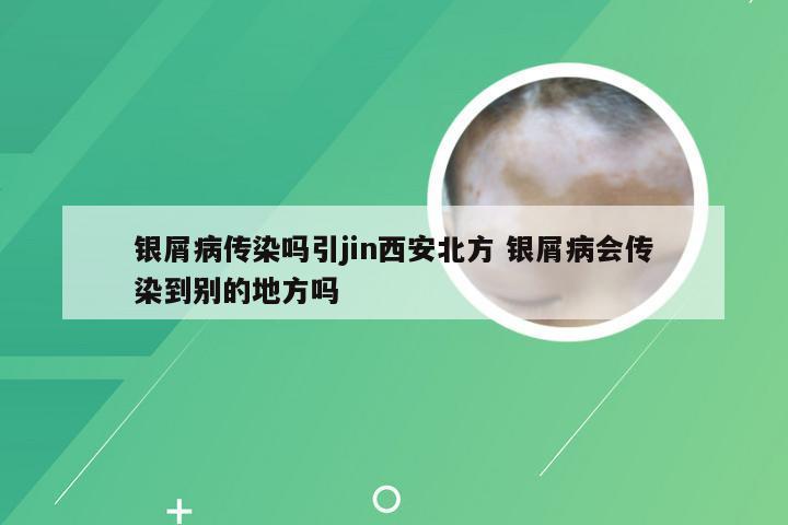 银屑病传染吗引jin西安北方 银屑病会传染到别的地方吗