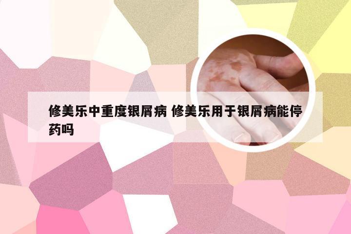 修美乐中重度银屑病 修美乐用于银屑病能停药吗