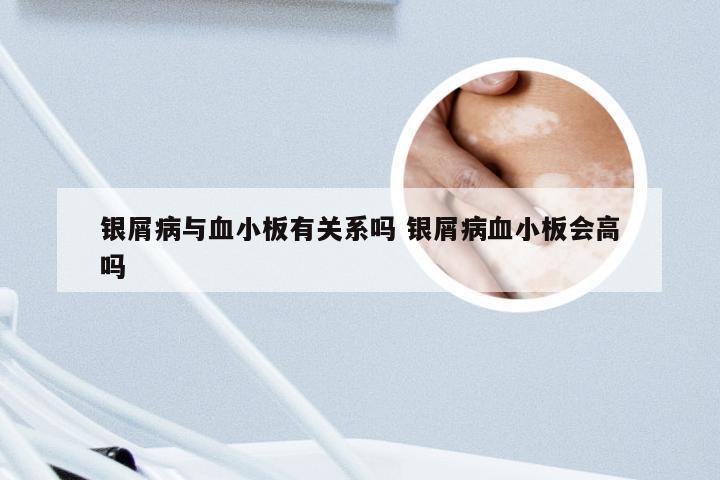 银屑病与血小板有关系吗 银屑病血小板会高吗