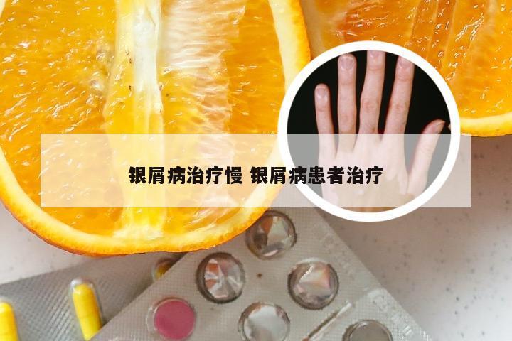 银屑病治疗慢 银屑病患者治疗