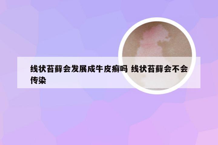 线状苔藓会发展成牛皮癣吗 线状苔藓会不会传染