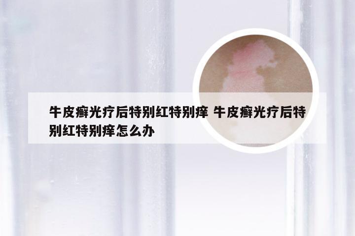 牛皮癣光疗后特别红特别痒 牛皮癣光疗后特别红特别痒怎么办