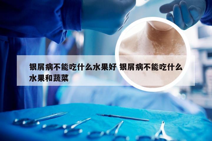 银屑病不能吃什么水果好 银屑病不能吃什么水果和蔬菜