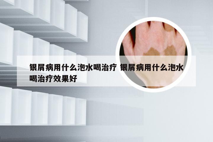 银屑病用什么泡水喝治疗 银屑病用什么泡水喝治疗效果好