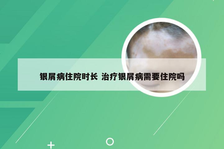 银屑病住院时长 治疗银屑病需要住院吗