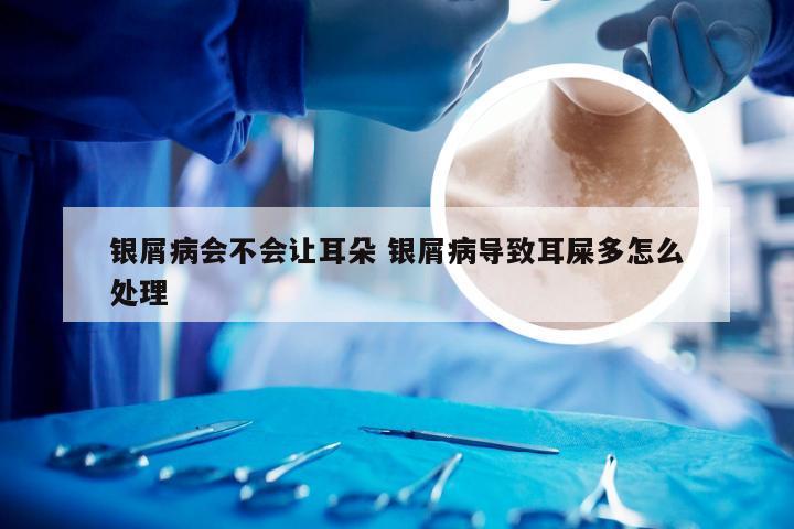 银屑病会不会让耳朵 银屑病导致耳屎多怎么处理