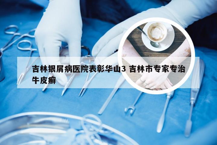 吉林银屑病医院表彰华山3 吉林市专家专治牛皮癣