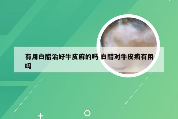 有用白醋治好牛皮癣的吗 白醋对牛皮癣有用吗