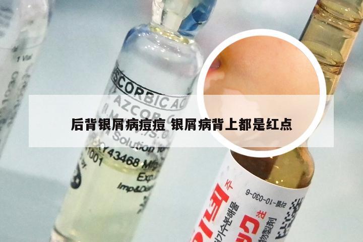 后背银屑病痘痘 银屑病背上都是红点
