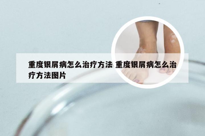 重度银屑病怎么治疗方法 重度银屑病怎么治疗方法图片