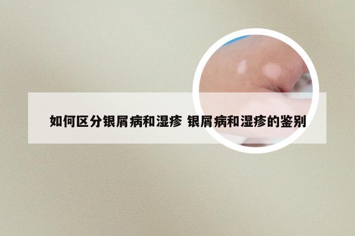 如何区分银屑病和湿疹 银屑病和湿疹的鉴别