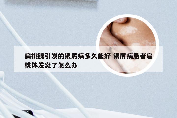 扁桃腺引发的银屑病多久能好 银屑病患者扁桃体发炎了怎么办