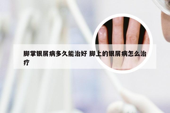 脚掌银屑病多久能治好 脚上的银屑病怎么治疗