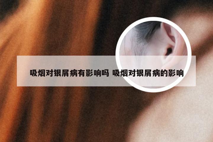 吸烟对银屑病有影响吗 吸烟对银屑病的影响