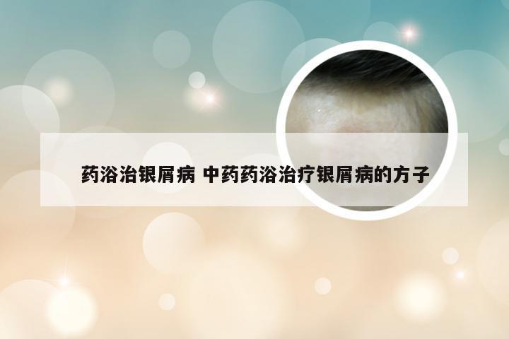 药浴治银屑病 中药药浴治疗银屑病的方子