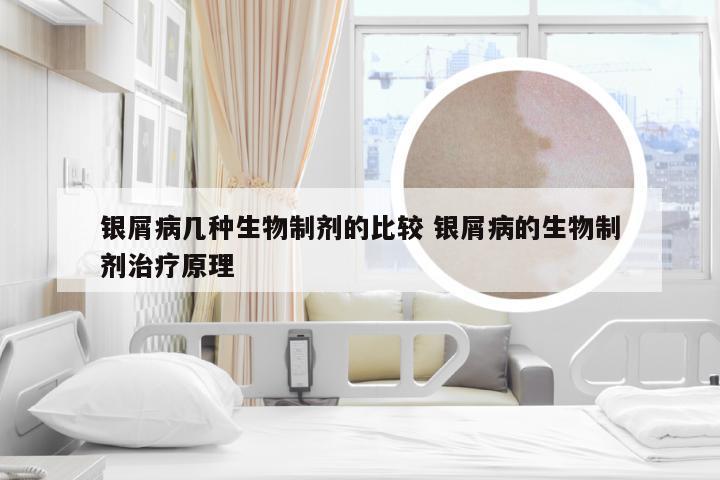 银屑病几种生物制剂的比较 银屑病的生物制剂治疗原理