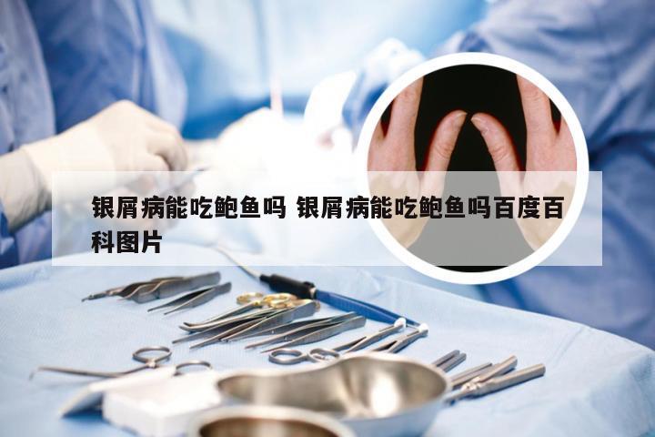 银屑病能吃鲍鱼吗 银屑病能吃鲍鱼吗百度百科图片