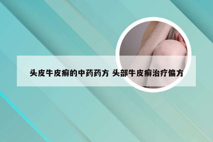 头皮牛皮癣的中药药方 头部牛皮癣治疗偏方