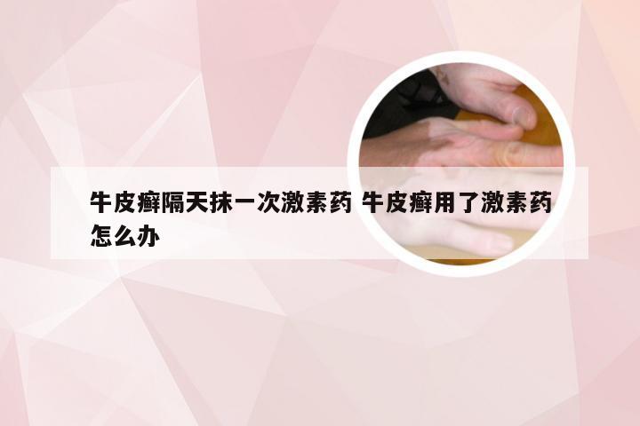 牛皮癣隔天抹一次激素药 牛皮癣用了激素药怎么办