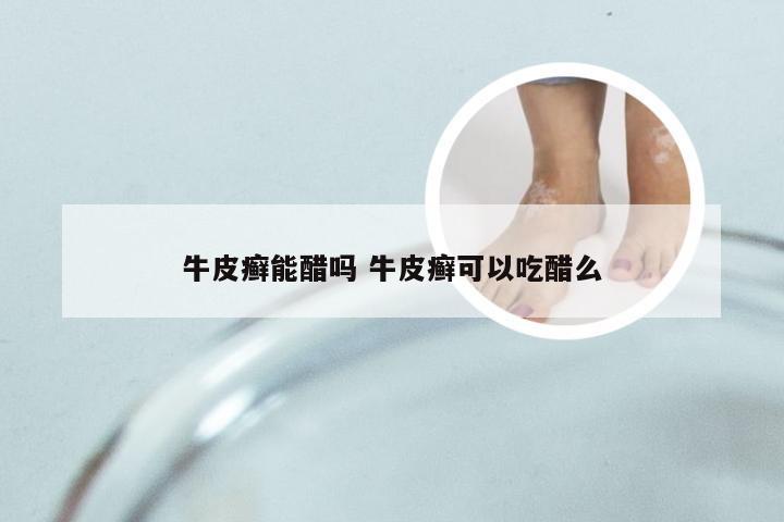 牛皮癣能醋吗 牛皮癣可以吃醋么