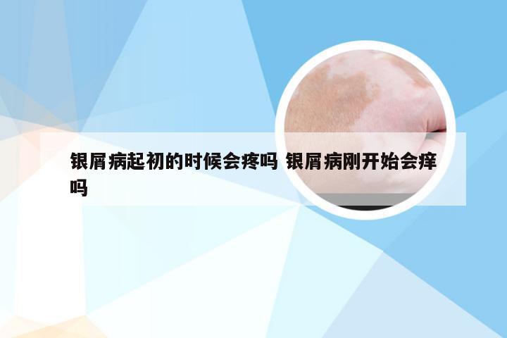 银屑病起初的时候会疼吗 银屑病刚开始会痒吗