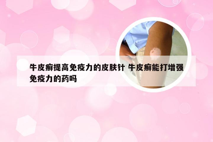 牛皮癣提高免疫力的皮肤针 牛皮癣能打增强免疫力的药吗