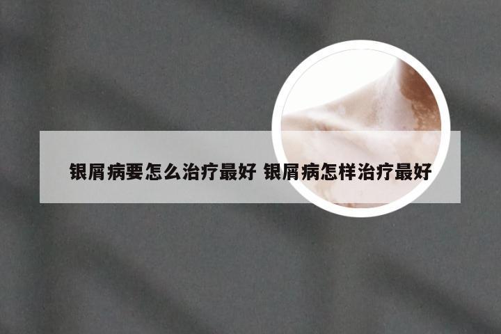 银屑病要怎么治疗最好 银屑病怎样治疗最好
