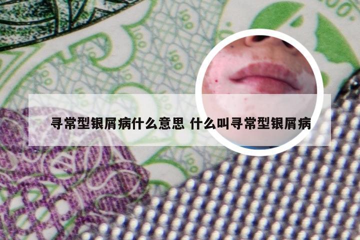 寻常型银屑病什么意思 什么叫寻常型银屑病