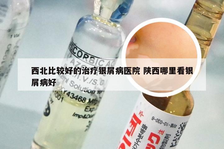 西北比较好的治疗银屑病医院 陕西哪里看银屑病好
