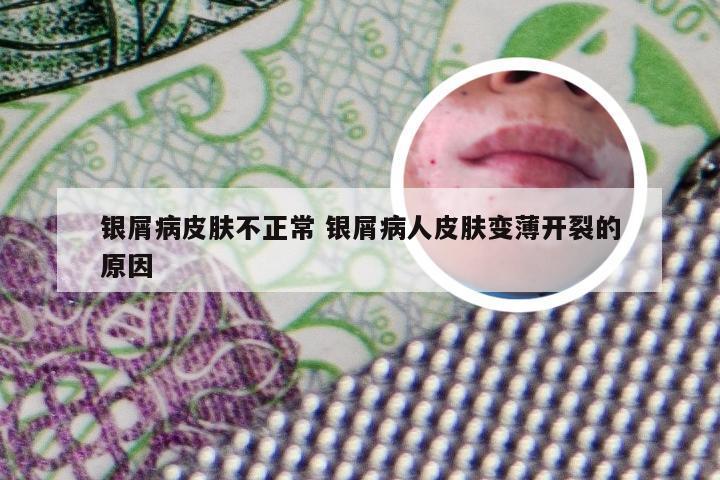 银屑病皮肤不正常 银屑病人皮肤变薄开裂的原因