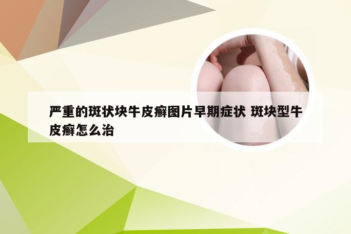 严重的斑状块牛皮癣图片早期症状 斑块型牛皮癣怎么治