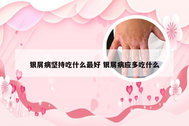 银屑病坚持吃什么最好 银屑病应多吃什么