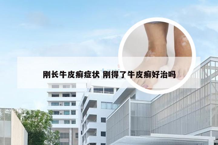 刚长牛皮癣症状 刚得了牛皮癣好治吗