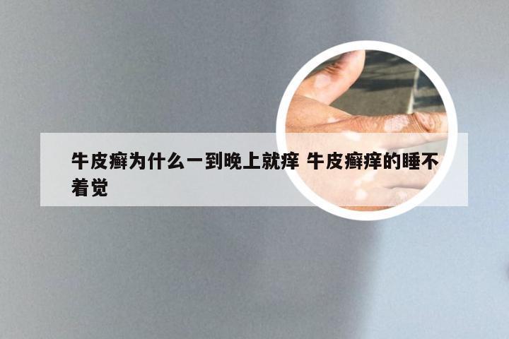 牛皮癣为什么一到晚上就痒 牛皮癣痒的睡不着觉