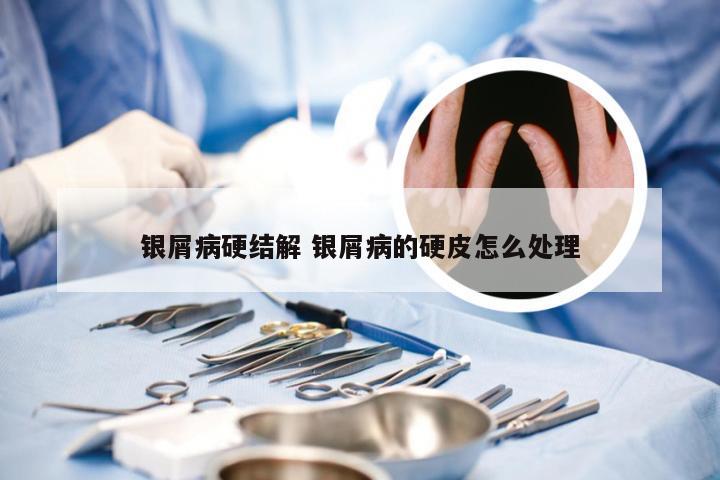 银屑病硬结解 银屑病的硬皮怎么处理