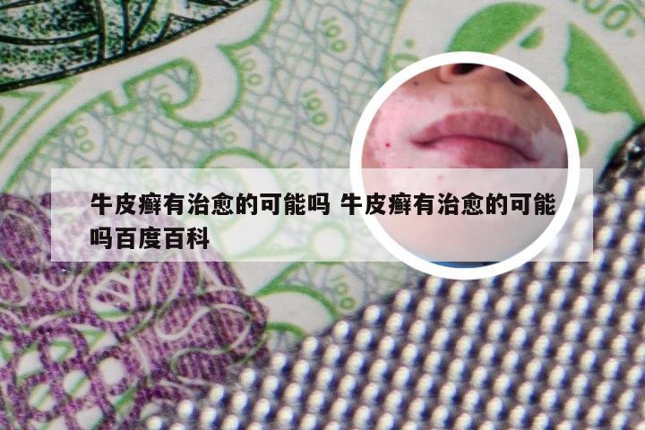牛皮癣有治愈的可能吗 牛皮癣有治愈的可能吗百度百科