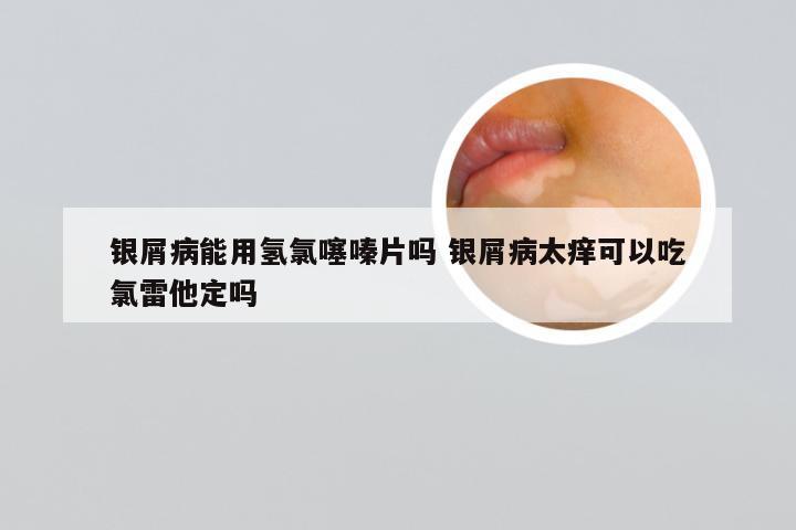 银屑病能用氢氯噻嗪片吗 银屑病太痒可以吃氯雷他定吗